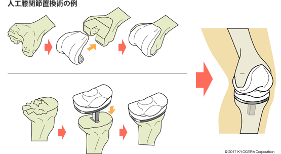 人工膝関節置換術の例