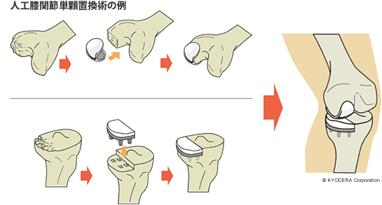 人工膝関節単顆置換術の例