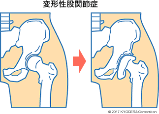 変形性股関節症