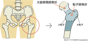 人工骨頭置換術