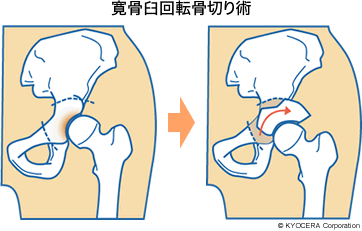 寛骨臼回転骨切り術