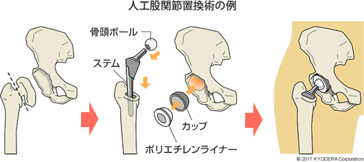 寛骨臼回転骨切り術