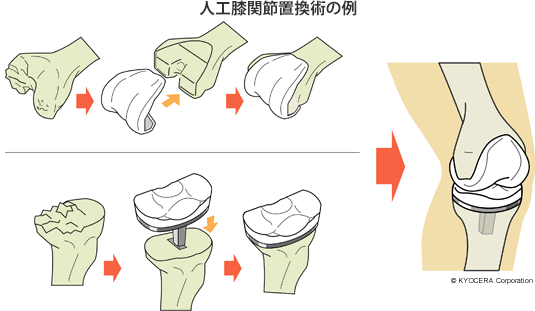 人工膝関節置換術の例