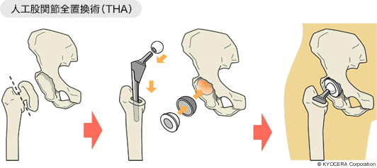 全人工股関節置換術