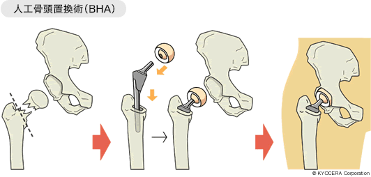 人工骨頭置換術