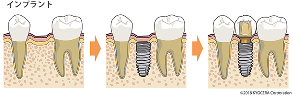 インプラント