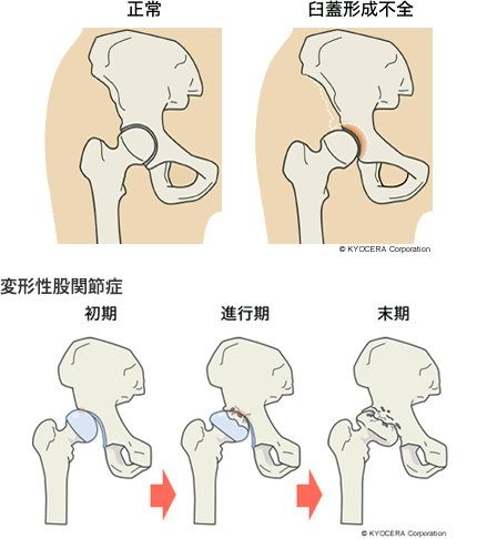 寛骨臼形成不全