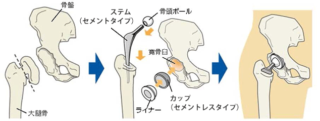 人工股関節手術 セメントタイプとセメントレスタイプ