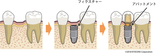 インプラント