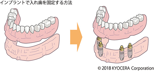 インプラントで入れ歯を固定する方法