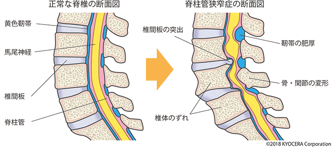 腰部脊柱管狭窄症