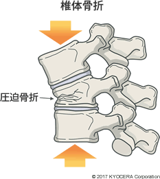 椎体骨折