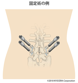 固定術の例