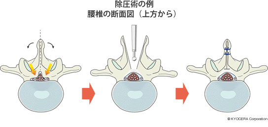 除圧術の例