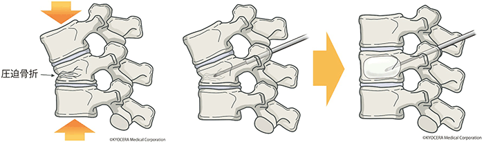 経皮的椎体形成術(けいひてきついたいけいせいじゅつ　BKP：Balloon Kyphoplasty)