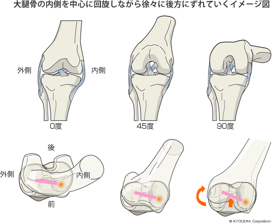 大腿骨の内側を中心に回旋しながら徐々に後方にずれていくイメージ図