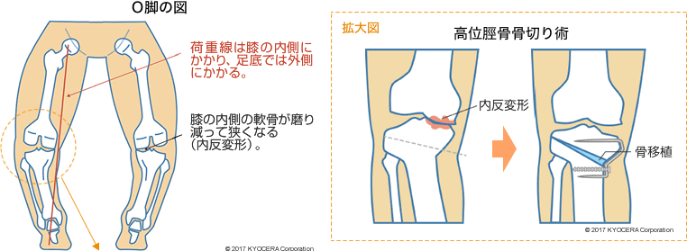 O脚の図