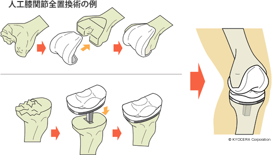 人工膝関節全置換術の例