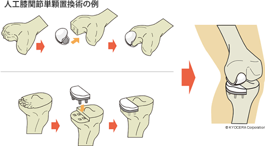 人工膝関節単顆置換術の例