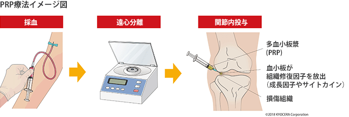 PRP療法