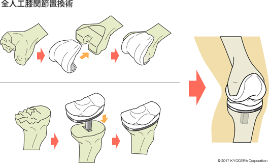 全人工膝関節置換術