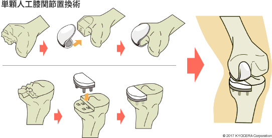 単顆人工膝関節置換術
