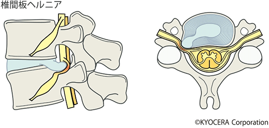 椎間板ヘルニア
