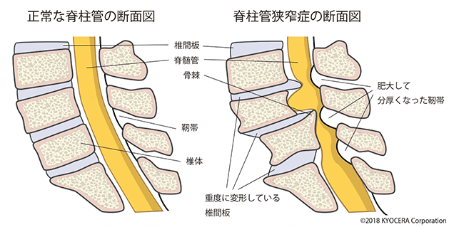 椎間板ヘルニア