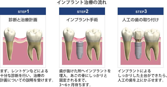 インプラント治療の流れ