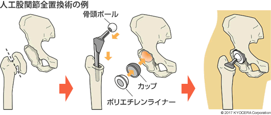 人工股関節全置換術の例