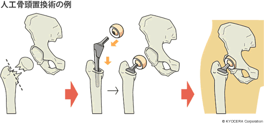 人工骨頭置換術の例