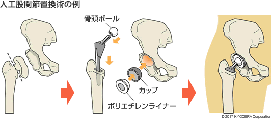 人工股関節置換術の例