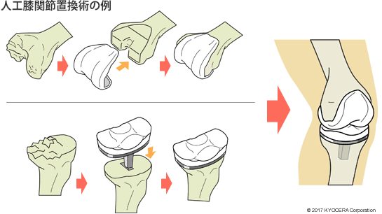 人工膝関節置換術の例