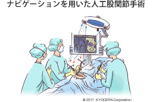 ナビゲーションを用いた人工股関節手術