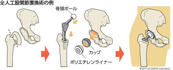 全人工股関節置換術の例