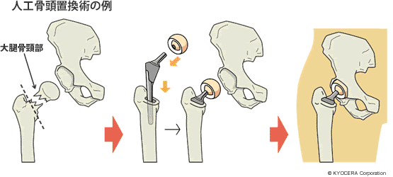 人工骨頭置換術の例