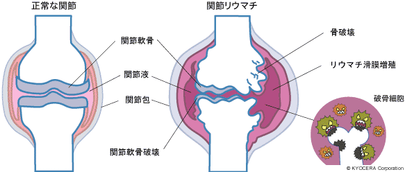 破骨細胞と骨芽細胞の働き