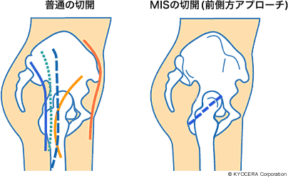 OCM法