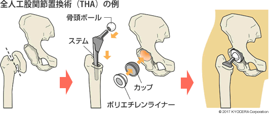 全人工股関節置換術（THA）の例