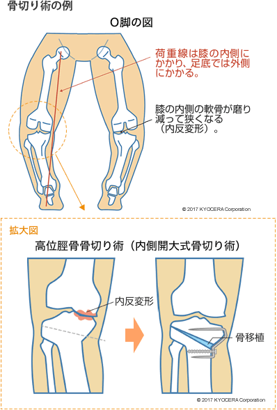 骨切り術の例