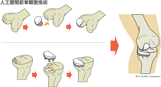 人工膝関節単顆置換術