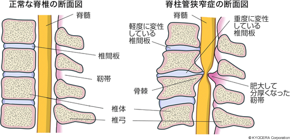 脊椎の断面図