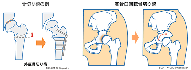 骨切り術