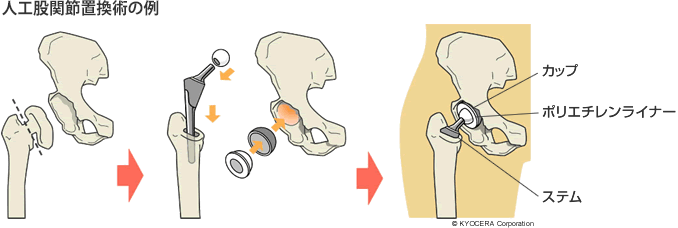 人工股関節置換術の例
