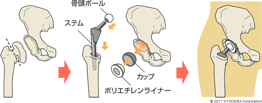 人工股関節置換術の例