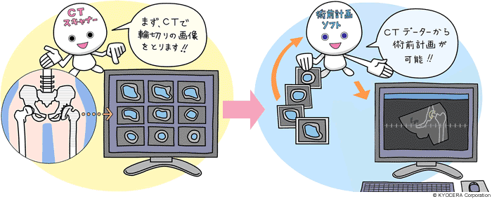 CTスキャナー　術前計画ソフト