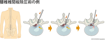 腰椎椎間板除圧術の例