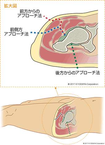 不全 難病 臼 蓋 形成