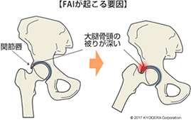 手術イコール人工股関節手術なのですか？ほかにも選択肢があるのでしょうか？