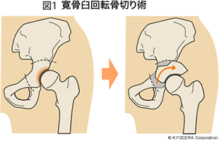 手術イコール人工股関節手術なのですか？ほかにも選択肢があるのでしょうか？